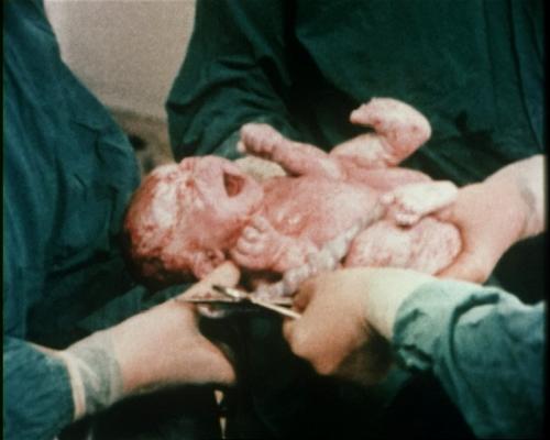 &lt;p&gt;Louise Brown, &amp;#39;s werelds eerste IVF-baby.&lt;/p&gt;